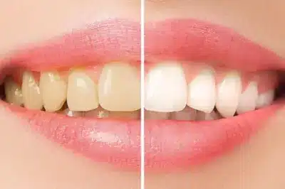 Bleaching Zahnarzt Köln