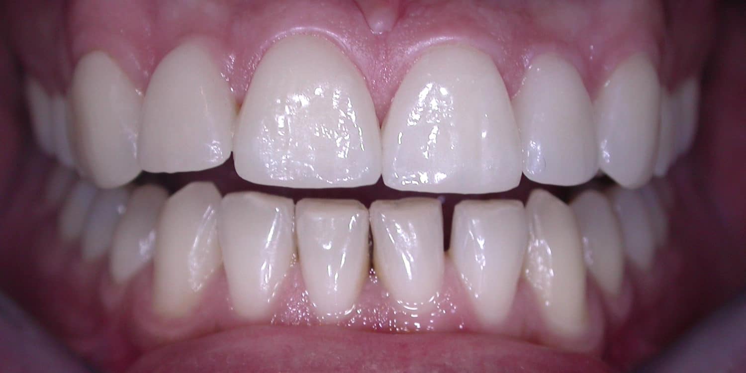 Zähne nach der Veneers-Behandlung bei den Zahnärzten im Bazaar in Köln