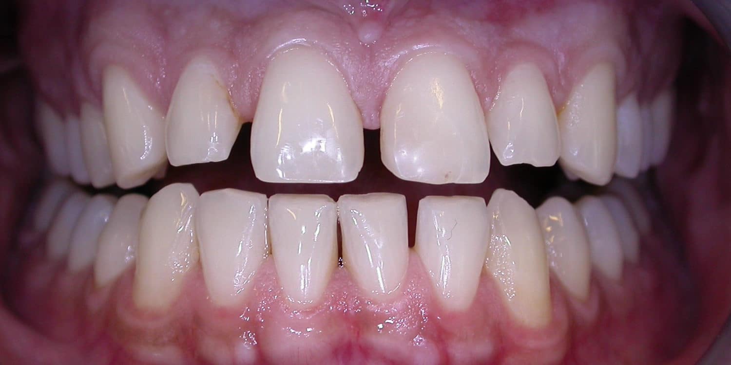 Zähne vor der Veneers-Behandlung in Köln