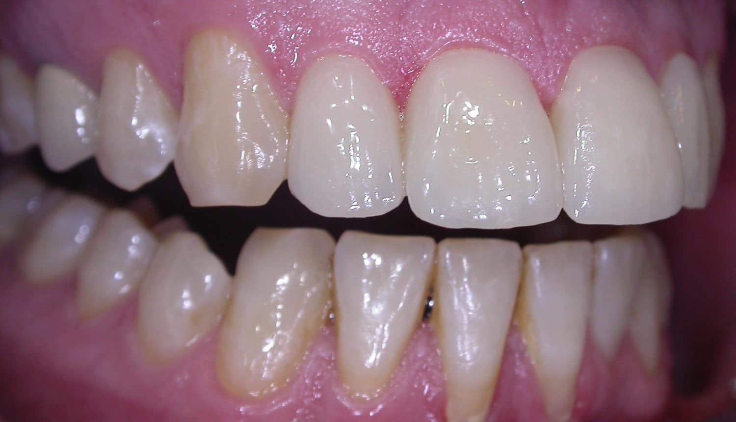 Zähne nach der Veneers-Behandlung bei den Zahnärzten im Bazaar in Köln
