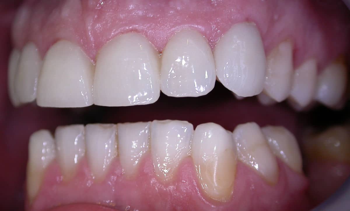 Zähne nach der Veneers-Behandlung bei den Zahnärzten im Bazaar in Köln